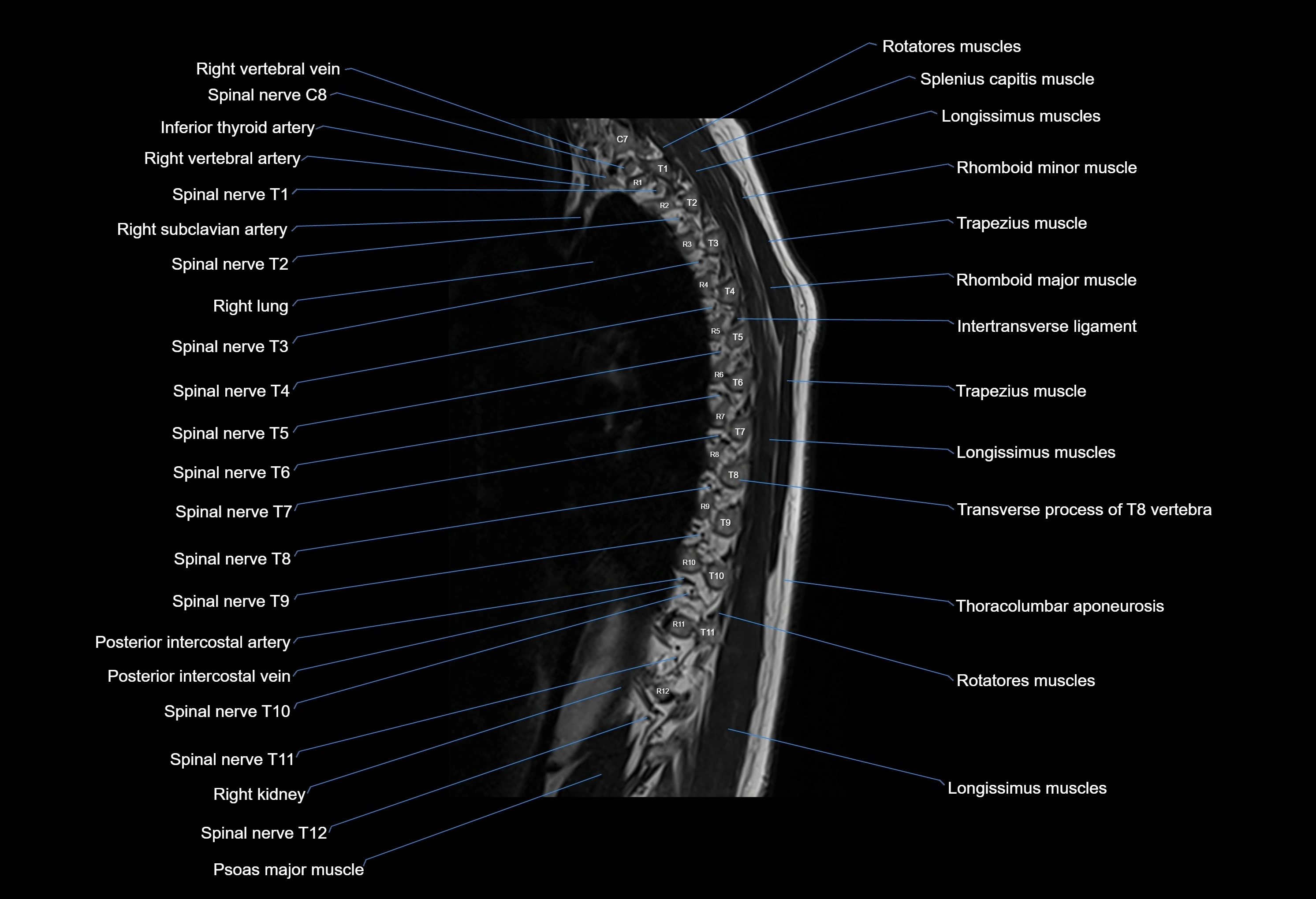 MRI thoracic spine sagittal  cross sectional anatomy 3T radiology  image-img-00001-00003.webp